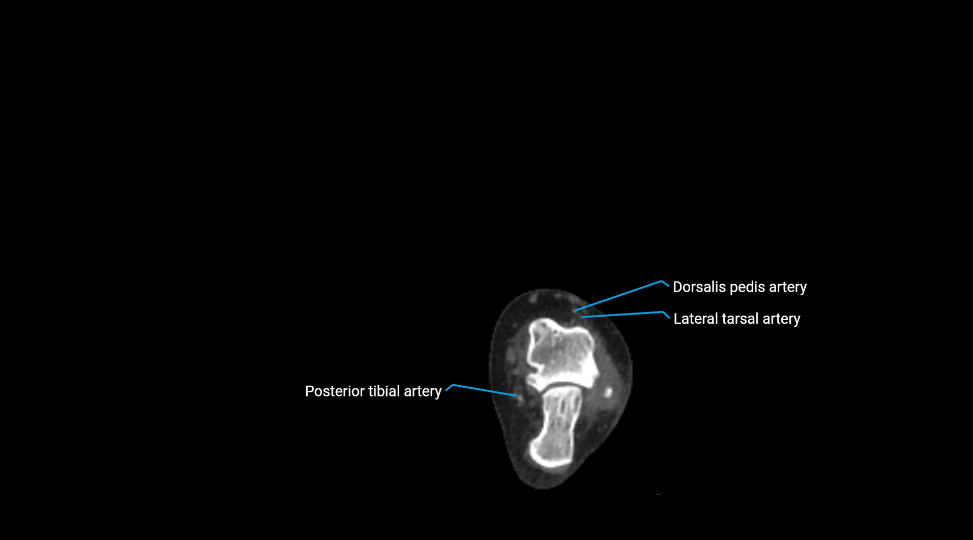 CTA lower limb cross sectional anatomy labelled image _277.webp